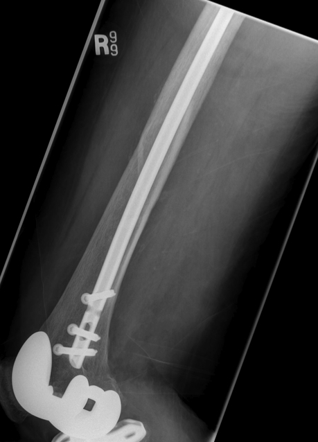 TKR Femoral Nail Lateral